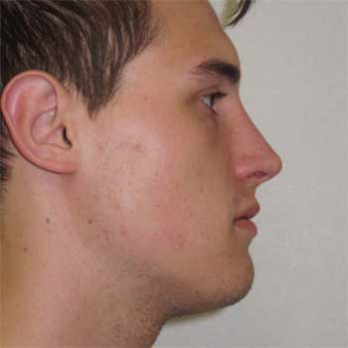 Side profile after rhinoplasty surgery