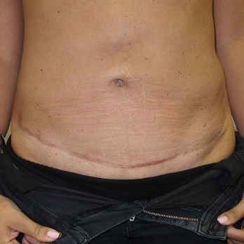 Front view of patient after Abdominoplasty surgery