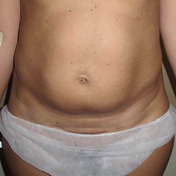 Front view of patient prior to Abdominoplasty surgery