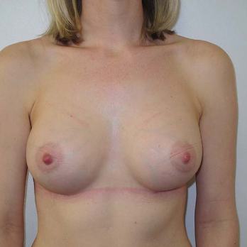 Front view of patient after Breast Augmentation surgery