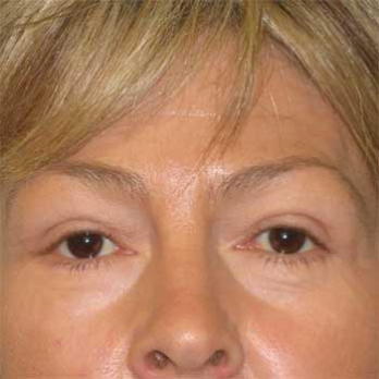 Front view of female patient after browlift surgery