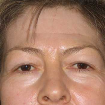 Front view of female patient prior to browlift surgery