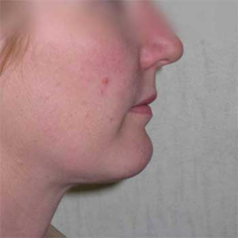 Side view of female patient after chin implant surgery