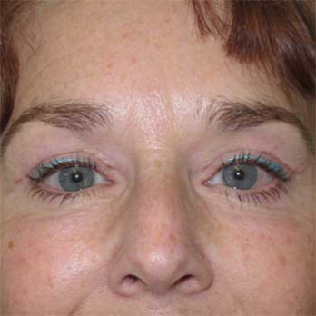 Side view of female patient after eyelid surgery