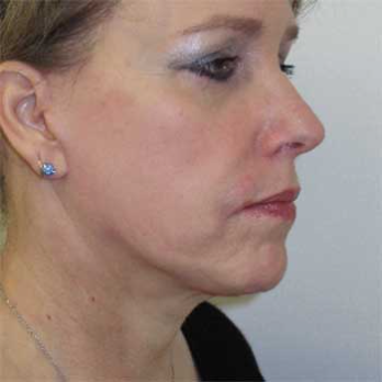 Side view of female paitent after Facelift surgery