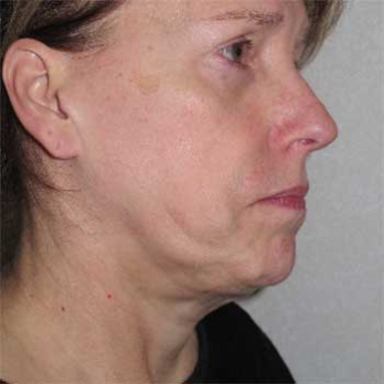 Side view of female paitent before Facelift surgery