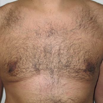 Front view of male patient after gynaecomastia surgery