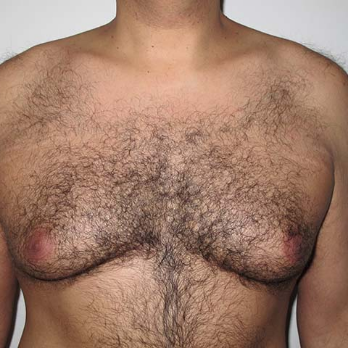 Front view of male patient prior to gynaecomastia surgery