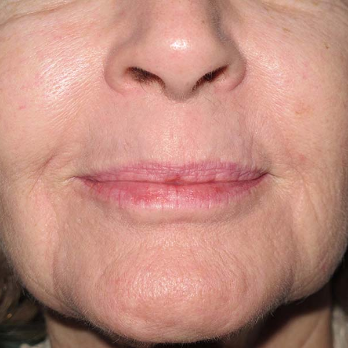 Front view of patient after Fractional laser resurfacing treatment