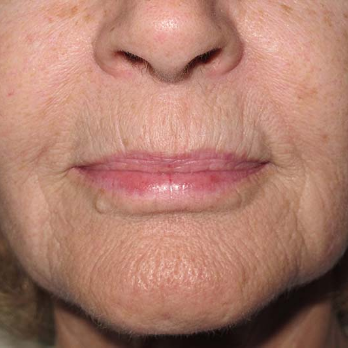 Front view of patient prior to Fractional laser resurfacing treatment