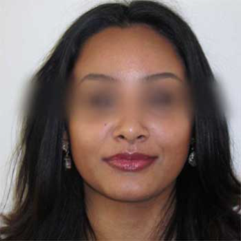 Front view after rhinoplasty surgery