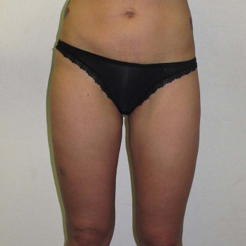 Back view of patient after VASER Liposelection surgery