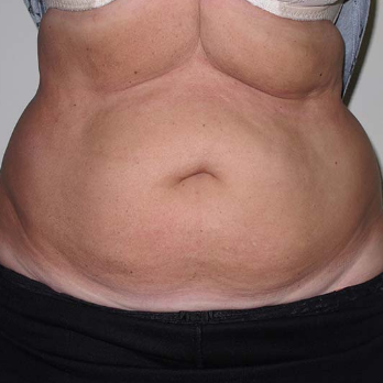 Front view of patient prior to Abdominoplasty surgery