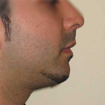 Side view of male patient after chin implant surgery
