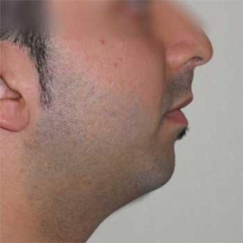 Side view of male patient prior to chin implant surgery