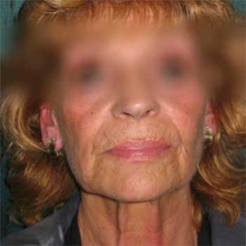 front view of female patient prior to Facelift surgery