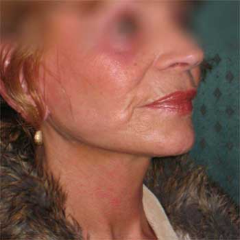 Side view of female paitent after Facelift surgery