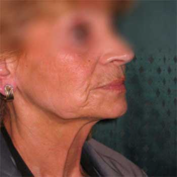 Side view of female paitent before Facelift surgery