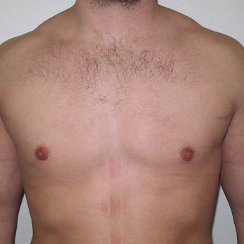 Front view of male patient after gynaecomastia surgery