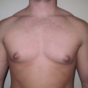 Front view of male patient prior to gynaecomastia surgery