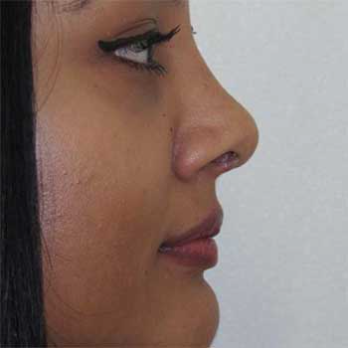 Side profile after rhinoplasty surgery