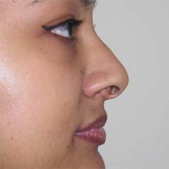 Side profile before rhinoplasty surgery