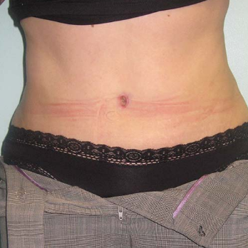 Front view of patient after Abdominoplasty surgery