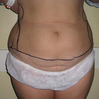 Front view of patient prior to Abdominoplasty surgery