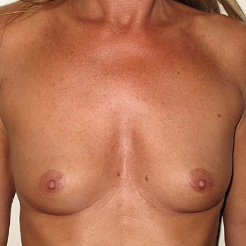 Front view of patient prior to Breast Augmentation surgery