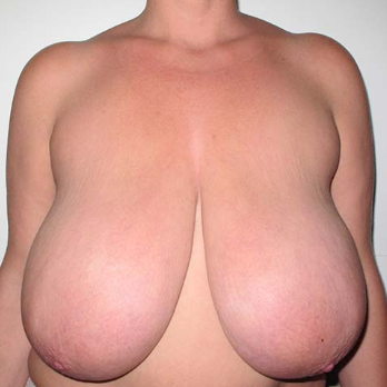 Front view of patient prior to breast reduction surgery
