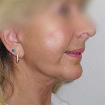 Side view of female patient after chin implant surgery