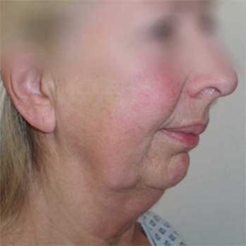 Side view of female patient before chin implant surgery