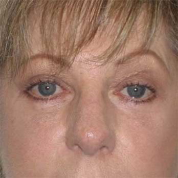 Side view of female patient aftter eyelid surgery