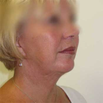 Side view of female paitent after Facelift surgery