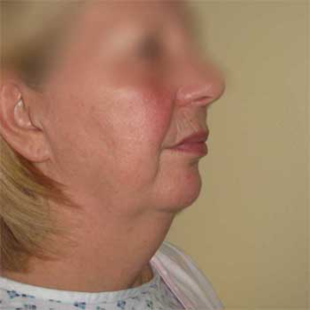 Side view of female paitent before Facelift surgery