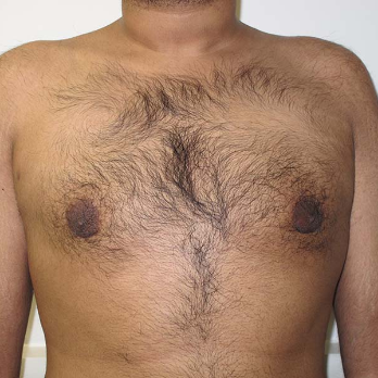 Front view of male patient after gynaecomastia surgery