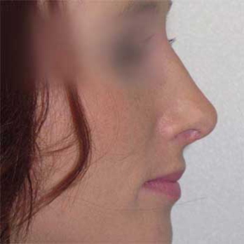 Side profile after rhinoplasty surgery