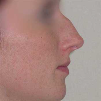 Side profile before rhinoplasty surgery