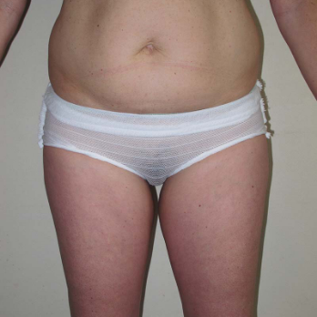 Back view of patient prior to VASER Liposelection surgery