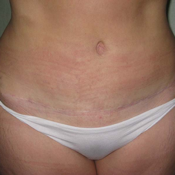 Front view of patient after Abdominoplasty surgery