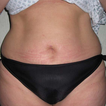 Front view of patient prior to Abdominoplasty surgery