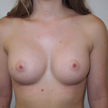 Front view of patient after Breast Augmentation surgery