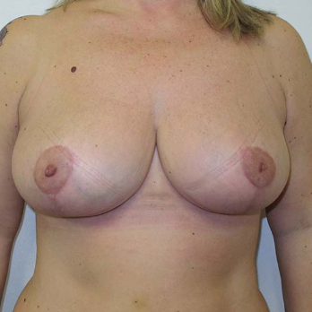 Front view of patient after breast reduction surgery