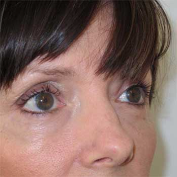 Side view of female patient aftter eyelid surgery