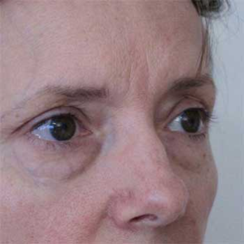 Side view of female patient prior to eyelid surgery