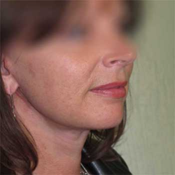 Side view of female paitent after Facelift surgery