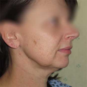 Side view of female paitent before Facelift surgery