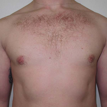 Front view of male patient after gynaecomastia surgery