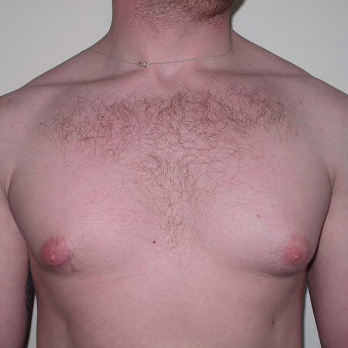 Front view of male patient prior to gynaecomastia surgery