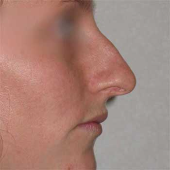 Side profile before rhinoplasty surgery